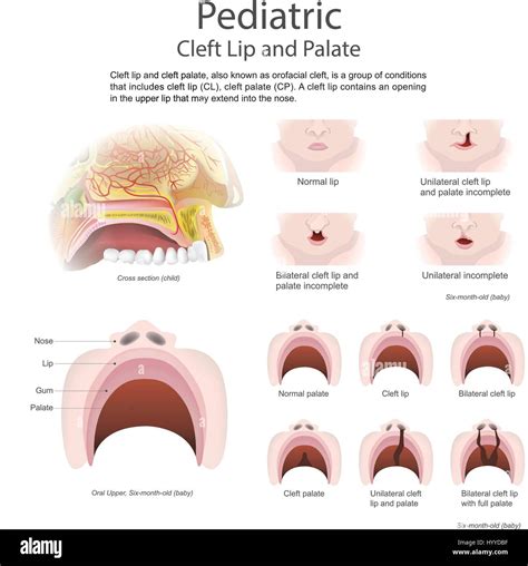 Cleft lip and cleft palate, also known as orofacial is a group of ...