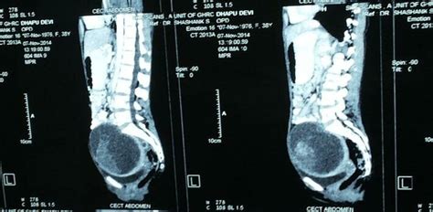 CT scan picture showing the mass. | Download Scientific Diagram