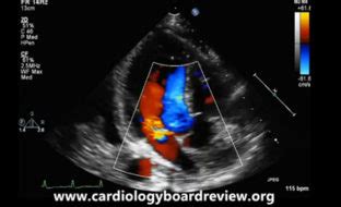 Echocardiogram: Substernal Plunging Goiter - MPR