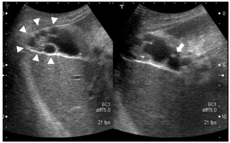 Diagnostics | Free Full-Text | A Case of Early-Stage Gallbladder Cancer, Positive for ALDH1A1 ...