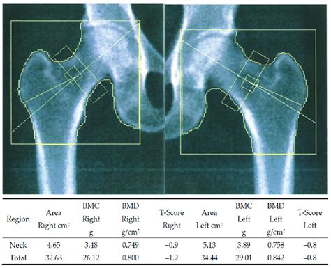 Left Femoral Neck Osteoporosis