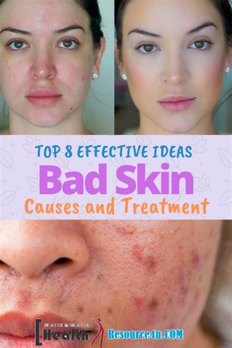 Bad Skin – Main Causes And Tips To Combat Them