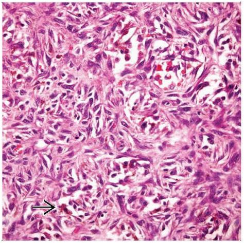 Histiocytoma Histology