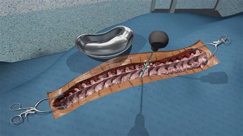 SPINE SURGERY Spinal Pedicle Screw - surgical simulation in VR with haptic touch