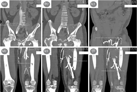 Control computed tomographic venography of a patient three months after ...