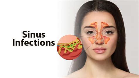 Sinus Infections: Are They Contagious? Common Myths Busted | TheHealthSite.com