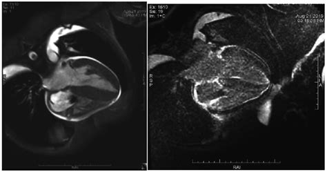 Echocardiography Cardiac magnetic resonance shows diffuse late ...