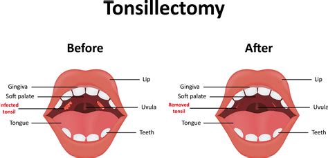 How To Get Rid Of Tonsil Stones - Creativeconversation4