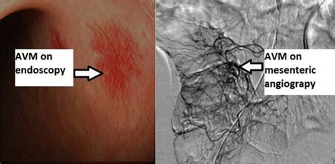 Systemic Octreotide Therapy in Prevention of Gastrointestinal Bleeds Related to Arteriovenous ...