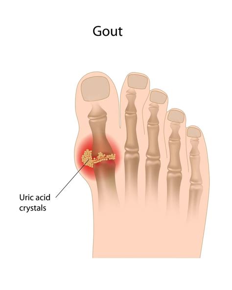 A Rare Case of Ulcerated Tophaceous Gout