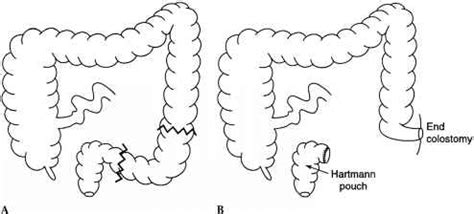 Hartmanns Procedure - Small Bowel - European Medical