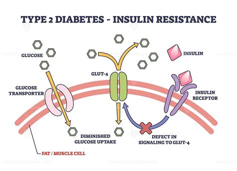 Type 2 diabetes and insulin resistance anatomical explanation outline diagram - VectorMine