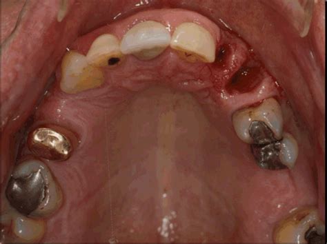Prosthodontics: Quiz #5