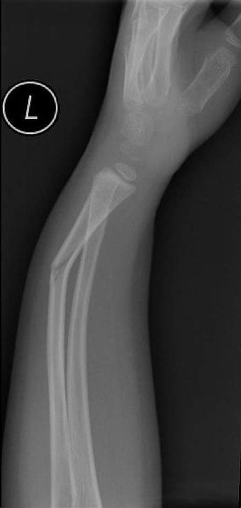 Greenstick Fracture X Ray