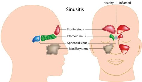 Great Tips About How To Fight A Sinus Infection Without Antibiotics ...