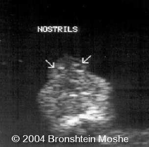 📃 Choanal atresia, unilateral