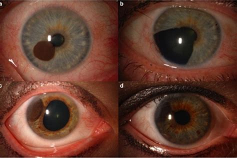 Eye Melanoma or Ocular Melanoma - The Eye News