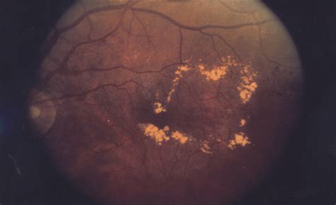 Macular edema - wikidoc