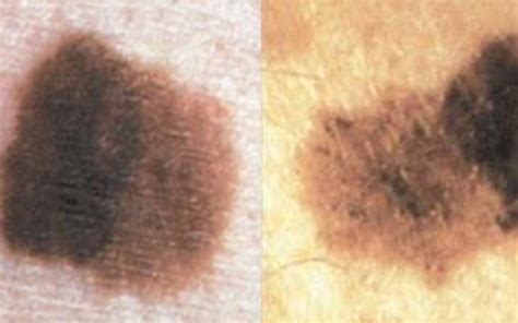 The Difference Between Melasma and Other Skin Spots | The Healthy