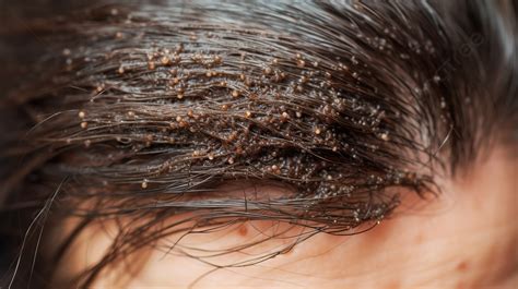شعر الشخص المصاب بعث الشعر, القمل أو صور قشرة الرأس صورة الخلفية للتحميل مجانا