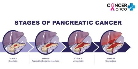 Pancreatic Cancer Treatment and Its 5 Stages