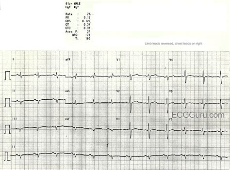 Dextrocardia | ECG Guru - Instructor Resources