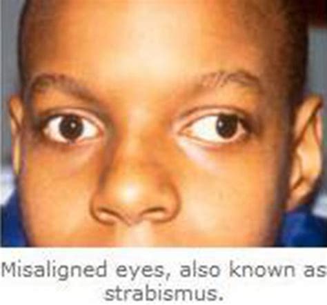 Amblyopia Treatment Orange County, CA | Lazy Eye, California