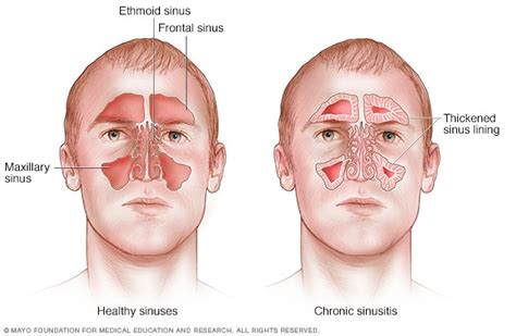 What is a Sinus Infection or Sinusitis and How to Cure it