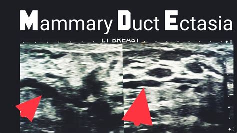 Mammary Duct Ectasia - YouTube