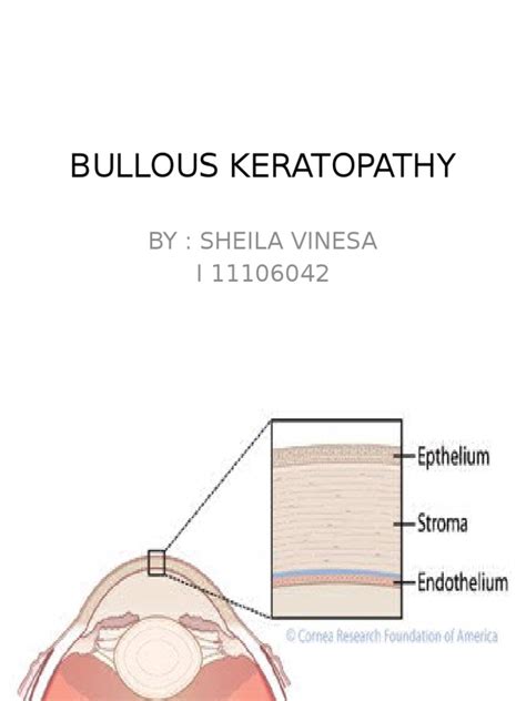 Bullous Keratopathy PR | PDF | Cornea | Ophthalmology