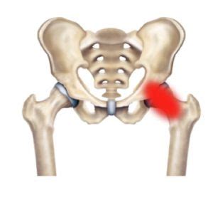 hip-joint-capsule-injury - City Hospital, Dehradun