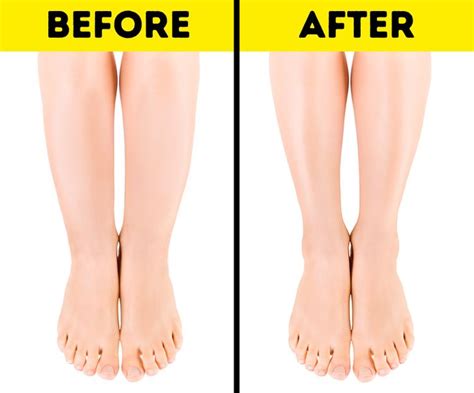 Why You Have Cankles and 7 Tips to Help You Deal Fix Them