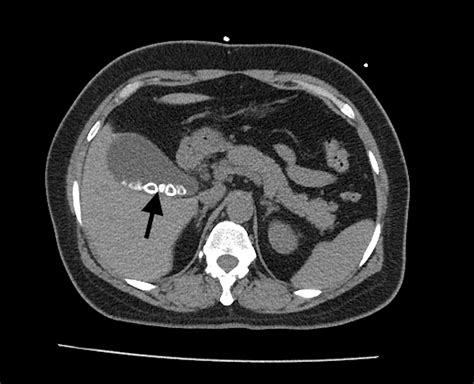 Acute Cholecystitis Presenting With Atypical Radiologic or Laboratory Findings: A Case Report ...