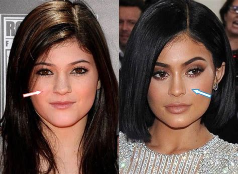 Kylie Jenner - Nose Job - before and after surgery #plasticsurgery ...