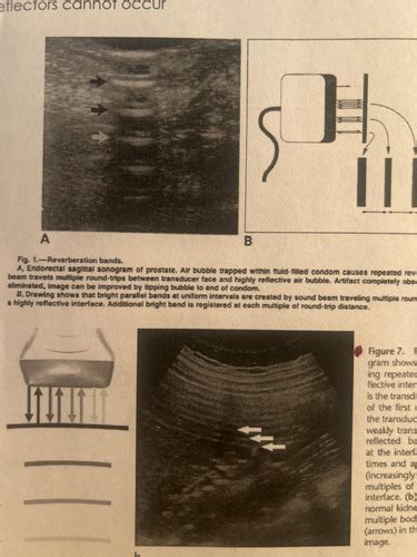 Artifacts ultrasound physics Flashcards | Quizlet