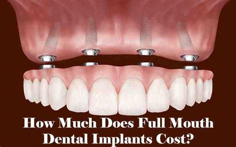 How much do full mouth dental implants cost - Dental News Network