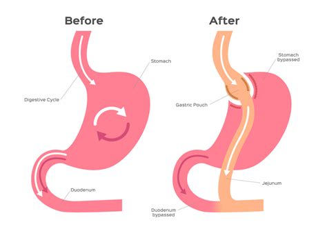 Gastric Bypass vs. Gastric Sleeve: Which One Is Right for You?