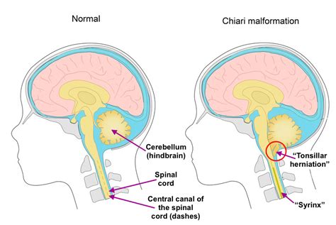 Arnold Chiari Type I Malformation | C.N.S. Neurosurgery