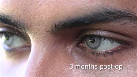 Eye color change surgery 3 months post op / brightocular - YouTube