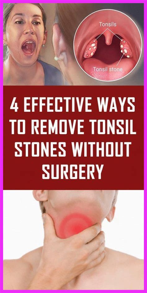 How To Stop Tonsil Bleeding - Facts about bleeding tonsils, most common cause of bleeding ...