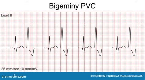 Electrocardiogram Show Bigeminy PVC Pattern. Stock Vector ...