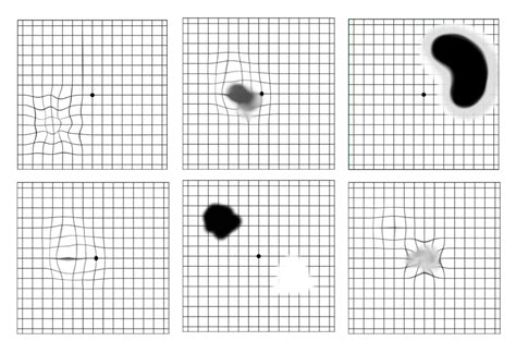 Printable Amsler Grid Chart