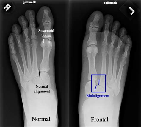 Metatarsal Stress Fracture - Fracture Treatment