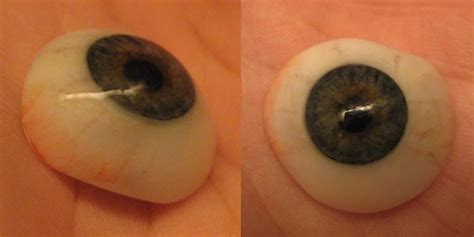 Ocular Prosthetics – Advanced Prosthetics and Orthotics