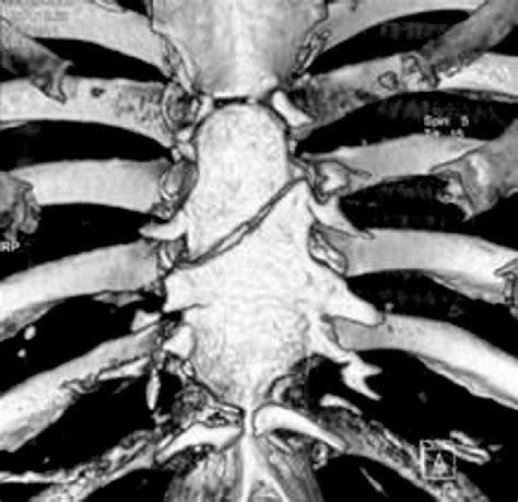 -CT scan. Dual source image shows complete transverse sternal fracture ...