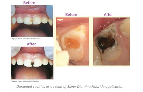 Tooth Decay Treatment Before And After