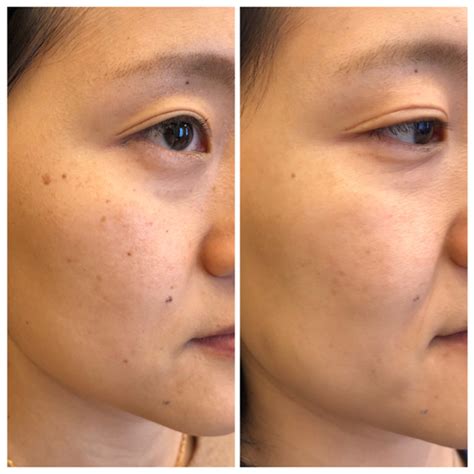 Newest and Best Lasers for Asian Skin: How to treat Hyperpigmentation ...