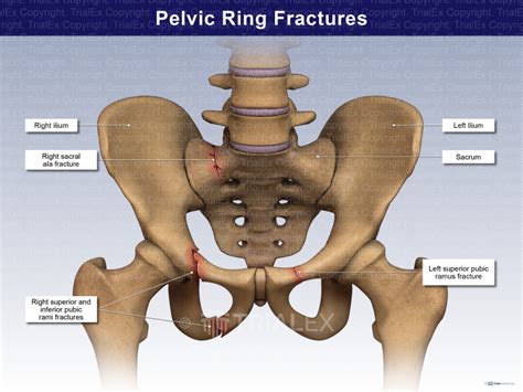 Pelvic Ring Fractures - TrialExhibits Inc.