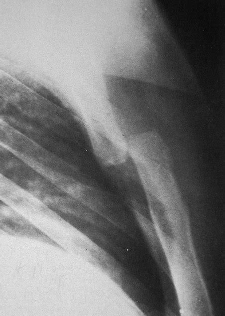 Sternum Pain (Breastbone) - Causes (Under, behind area)