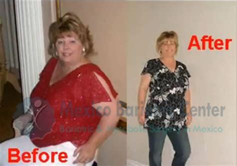 Lap Band Before and After Photos - Real Patient Transformations